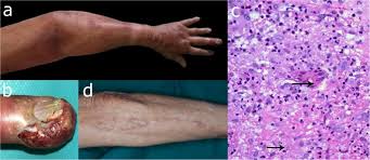 Image result for Nodular Lymphangitis