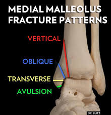It is a part of the bone of the lower leg and can be easily felt with hands on the inner side. 5 Kinds Of Fractures From A Twisted Ankle In 2021 Broken Ankle Ankle Fracture Broken Ankle Recovery