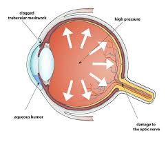 The optic nerve carries sight impulses from the eye retina to the visual cortex in the brain. Glaucoma Seattle Glaucoma Treatment Bellevue Specialty Eyecare