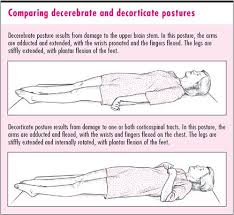 Comparing Decerebrate And Decorticate Posturing Nursing Study Guide Acute Nursing Medical Knowledge