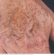 Image result for liver spots on legs
