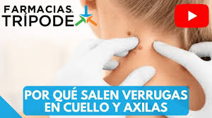 Como Eliminar Verrugas En El Cuello Por Que Salen Verrugas En El Cuello Y Axilas Youtube