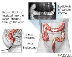 Colon Cancer Information | Mount Sinai - New York