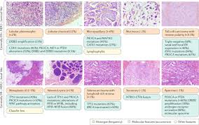 Cancer cells can spread to other parts of the body through the blood and lymph systems, which help the body get rid of toxins. Breast Cancer Nature Reviews Disease Primers