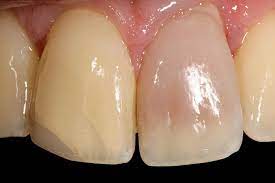 Med Bleaching Sanft Strahlend Schon Dr Hansen Munchen