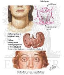 It frequently results in and is the most common cause of hyperthyroidism. Graves Disease Thyroid And Ocular Pathology
