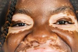 Image result for Vitiligo