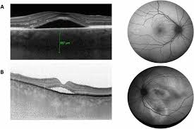 Pour une durée de 6 ans sur demande du préfet de région. Lipocalin 2 As A Potential Systemic Biomarker For Central Serous Chorioretinopathy Scientific Reports