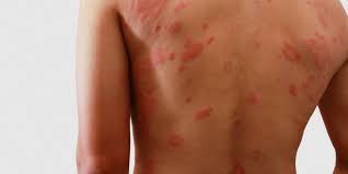 Hiv adalah singkatan dari human immunodeciency virus. Ruam Hiv Apakah Berbeda Dari Ruam Pada Umumnya