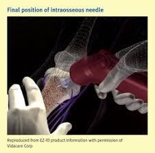 Image result for Difficult Intravenous Access in Children