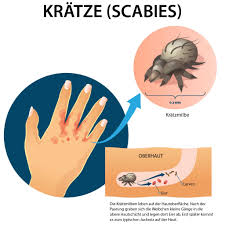 Einziges mittel gegen krätze, das geschluckt wird. Kratze Scabies Ursache Beschwerden Behandlung