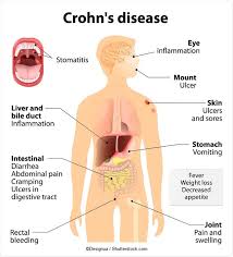 Cause, symptômes, alimentation et traitement. Histoire De La Maladie De Crohn