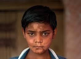 Since being founded in 1924 they have helped to diagnose, treat and rehabilitate people affected by leprosy. About Leprosy Lepra