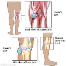 Webmd explains common things that can cause knee pain. Knee Osteoarthritis My Doctor Online