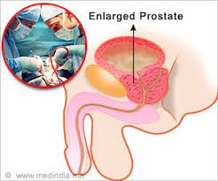 Enlarged Prostate May Not Need Surgery Enlarged Prostate Prostate Prostate Health