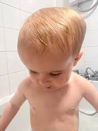 My son is 17 months and he saw the consultant at great ormand street UK in  January for suspected Craniosynostosis. They said he hasn't got it and he  will grow into his