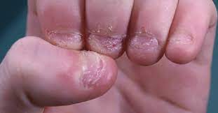 Nail biting is a bad habit that can make your hands look unsightly. Why You Must Stop Biting The Skin Around Your Fingernails