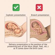 Image result for Breech Presentation