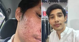 Ya, memang benar bahwa jerawat pasir memiliki kesamaan dengan jerawat pada umumnya namun terdapat. Pernah Nak Gosok Muka Pakai Kertas Pasir Tapi Wajah Penuh Jerawat Lelaki Ini Kembali Pulih Dengan Modal Hanya Rm 7 Vanilla Kismis