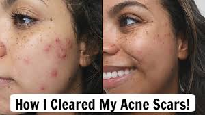 You'll see visible improvements in fine lines & wrinkles, smoothness, brightness, firming, dark spots. Olay Retinol24 Review Easy Tips For Glowy Clear Skin Youtube