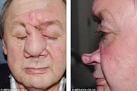 Người đàn ông tái tạo mũi từ xương và da chân