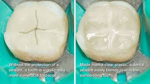 Before acid etching to improve sealant retention57. Dental Sealants