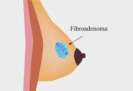 Rinse off in the morning. Lump In Breast While Breastfeeding Types Treatment Prevention