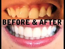 Considered to be the least painful of all the procedures. My Teeth Before After Invisalign Zoom Teeth Whitening Veneers Youtube