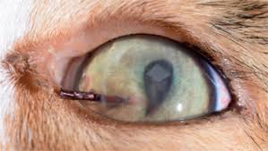 Image result for Eye Foreign Body