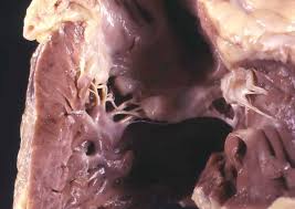 Vídeo narra descrição histopatológica detalhada da trombose pulmonar. Que Es La Trombosis Pulmonar