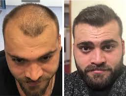 Hair transplant before and after pictures