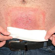 How long does heat rash last? A Persistent Rash Eludes Treatment Clinician Reviews