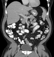 Image result for CT Intravenous Contrast