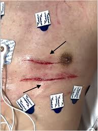 Image result for Chest Trauma