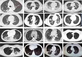 But distribution issues aside, a study from the massachusetts institute of technology out last week is raising further concerns about those vaccines' effectiveness.after initial human trials, moderna reported its vaccine to be 94 percent effective in. A Comprehensive Study On Classification Of Covid 19 On Computed Tomography With Pretrained Convolutional Neural Networks Scientific Reports