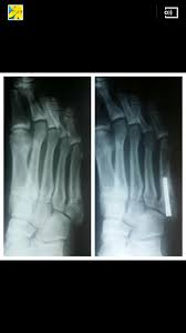 Postoperative treatment is similar to those listed above, under conservative treatment. Dez Bryant Foot Fracture And Bone Graft Top 10 Things To Know National Football Post