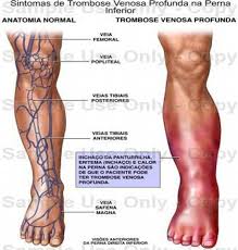 Una complicación común que puede ocurrir después de la trombosis venosa profunda es el síndrome posflebítico, también llamado síndrome postrombótico. Trombosis Venosa Profunda Monografias Com