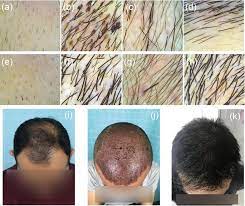 Maybe you would like to learn more about one of these? Large Scale Beard Extraction Enhances The Cosmetic Results Of Scalp Hair Restoration In Advanced Androgenetic Alopecia In East Asian Men A Retrospective Study Springerlink