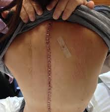 Pin On Scoliosis Surgery