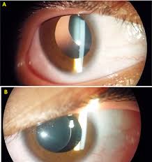 Ectopia Lentis In Marfan Syndrome