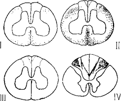 Image result for Ergotism