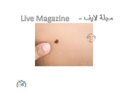 يبدأ باكراً في الحياة، ويختلف عن وحمة بيكر. ÙˆØ­Ù…Ø© Ø¨ÙŠÙƒØ± Ø§Ù„Ø£Ø³Ø¨Ø§Ø¨ ÙˆØ­Ù…Ø© Ø¨ÙŠÙƒØ± Live Magazine Ù…Ø¬Ù„Ø© Ù„Ø§ÙŠÙ Facebook
