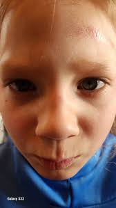 Helping a friend recover from a broken collarbone with a delicious meal