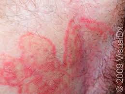Image result for sore skin in the groin area