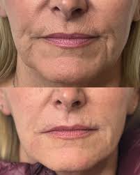 Angela Kane, RN, Advanced Nurse Injector, Educator