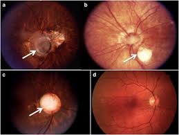 Image result for Coloboma