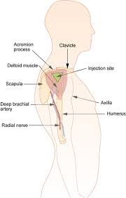 An intramuscular (im) injection is a shot of medicine given into a muscle. File Im Deltoid Png Wikimedia Commons