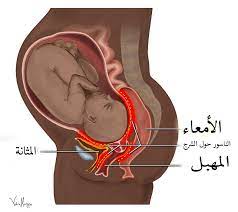 ناسور الولادة ويكيبيديا