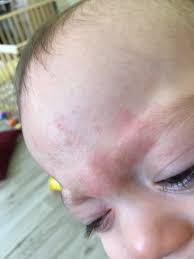 Image result for vyrážka u dětí