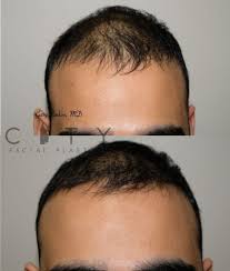 Check out 17 of the best fixes and remedies for hair loss. Nyc Prp For Hair Loss New York Cosmetic Plastic Surgery Ues